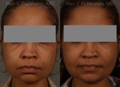 Dermal Fillers Before and After Photos in Newburgh, NY, Patient 12707