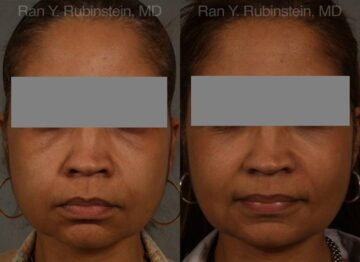 Dermal Fillers Before and After Photos in Montvale, NJ, Patient 12707