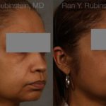 Dermal Fillers Before and After Photos in Newburgh, NY, Patient 12707