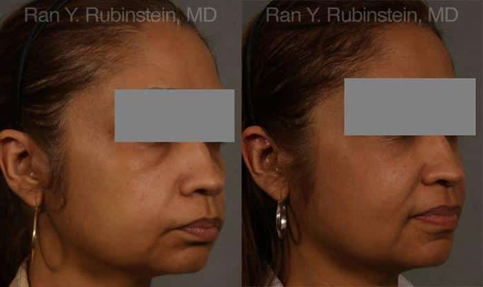 Dermal Fillers Before and After Photos in Newburgh, NY, Patient 12707