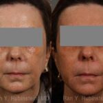 Dermal Fillers Before and After Photos in Newburgh, NY, Patient 12717