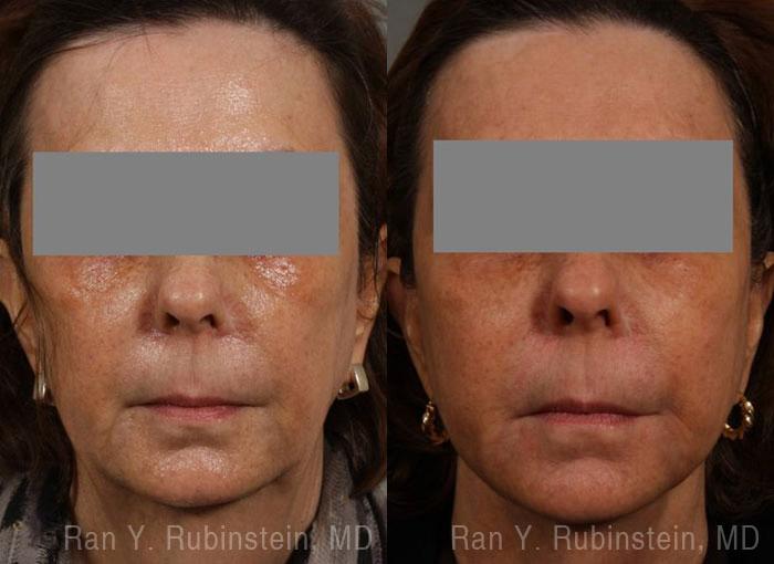 Dermal Fillers Before and After Photos in Newburgh, NY, Patient 12717