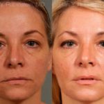 Dermal Fillers Before and After Photos in Newburgh, NY, Patient 12722