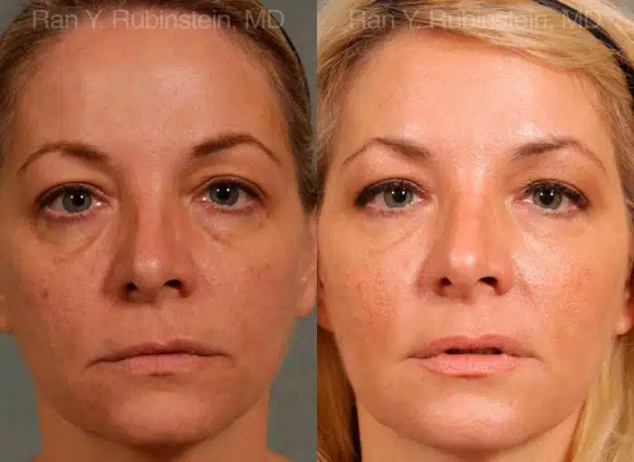 Dermal Fillers Before and After Photos in Newburgh, NY, Patient 12722