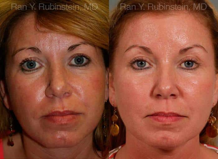 Dermal Fillers Before and After Photos in Newburgh, NY, Patient 12728