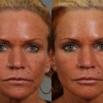 Dermal Fillers Before and After Photos in Newburgh, NY, Patient 12731