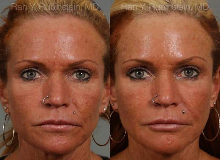 Dermal Fillers Before and After Photos in Newburgh, NY, Patient 12731