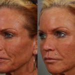 Dermal Fillers Before and After Photos in Newburgh, NY, Patient 12731