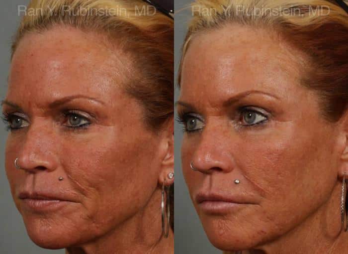 Dermal Fillers Before and After Photos in Newburgh, NY, Patient 12731