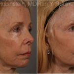 Dermal Fillers Before and After Photos in Newburgh, NY, Patient 12739