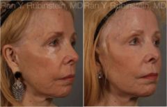 Dermal Fillers Before and After Photos in Newburgh, NY, Patient 12739