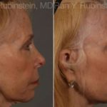 Dermal Fillers Before and After Photos in Newburgh, NY, Patient 12739