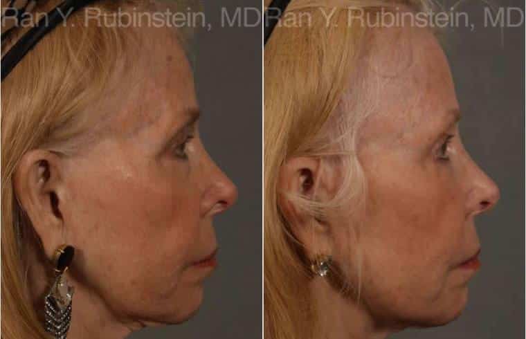 Dermal Fillers Before and After Photos in Newburgh, NY, Patient 12739