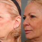 Sculptra Face Before and After Photos in Newburgh, NY, Patient 12744