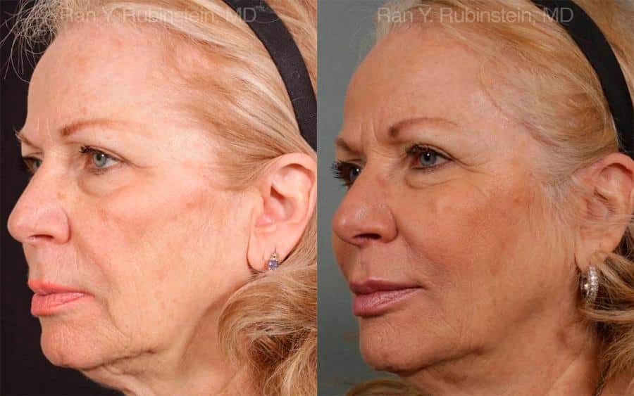 Sculptra Face Before and After Photos in Newburgh, NY, Patient 12744