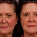 Dermal Fillers Before and After Photos in Newburgh, NY, Patient 12750