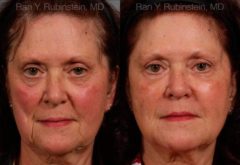 Dermal Fillers Before and After Photos in Newburgh, NY, Patient 12750