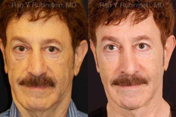 Dermal Fillers Before and After Photos in Newburgh, NY, Patient 12753