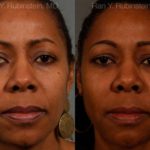 Dermal Fillers Before and After Photos in Newburgh, NY, Patient 12756