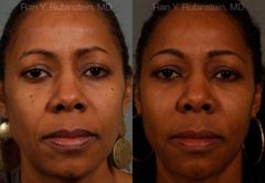 Dermal Fillers Before and After Photos in Newburgh, NY, Patient 12756