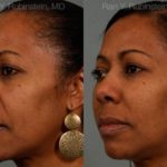 Dermal Fillers Before and After Photos in Newburgh, NY, Patient 12756