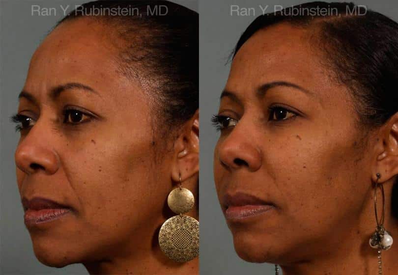 Dermal Fillers Before and After Photos in Newburgh, NY, Patient 12756