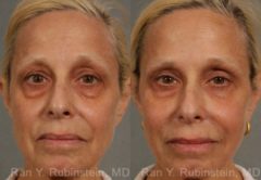 Dermal Fillers Before and After Photos in Newburgh, NY, Patient 12766