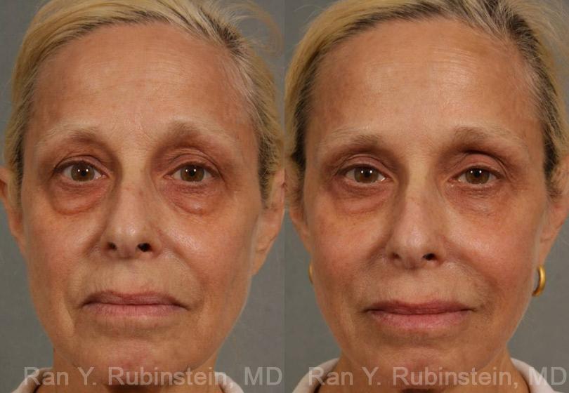 Injectable Fillers Before and After Photos in Newburgh, NY, Patient 12766
