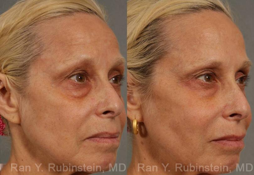Injectable Fillers Before and After Photos in Newburgh, NY, Patient 12766