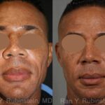 Sculptra Face Before and After Photos in Newburgh, NY, Patient 12771