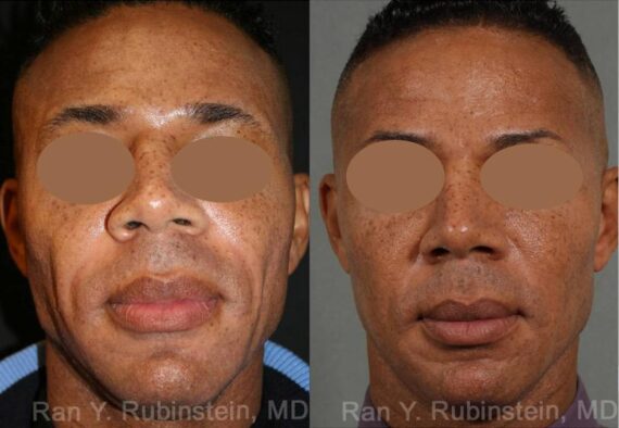 Sculptra Face Before and After Photos in Newburgh, NY, Patient 12771