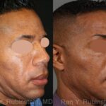 Sculptra Face Before and After Photos in Newburgh, NY, Patient 12771