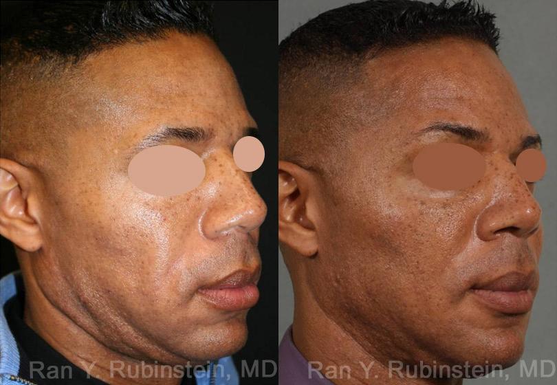 Sculptra Face Before and After Photos in Newburgh, NY, Patient 12771