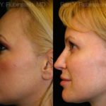 Sculptra Face Before and After Photos in Newburgh, NY, Patient 12782