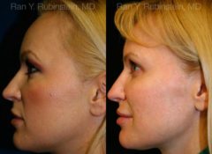 Sculptra Face Before and After Photos in Newburgh, NY, Patient 12782