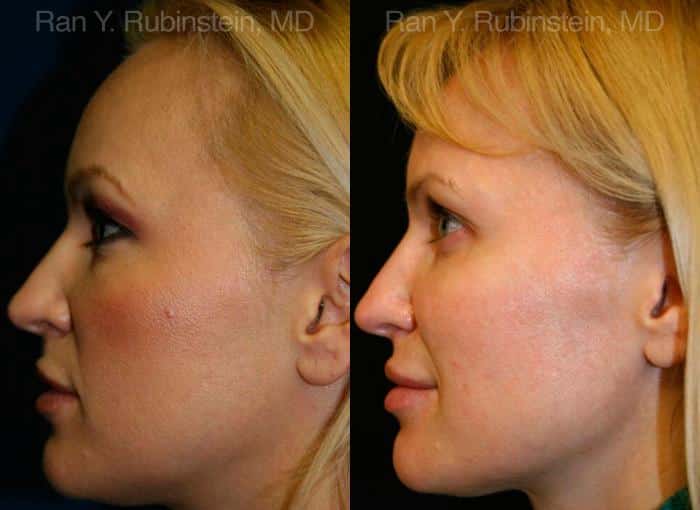 Sculptra Face Before and After Photos in Newburgh, NY, Patient 12782