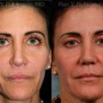 Sculptra Face Before and After Photos in Newburgh, NY, Patient 12788