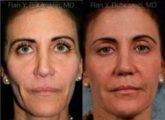 Sculptra Face Before and After Photos in Newburgh, NY, Patient 12788