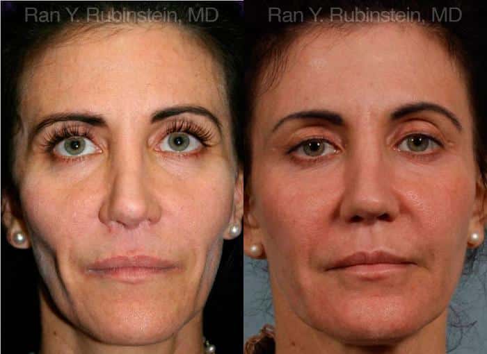 Sculptra Face Before and After Photos in Newburgh, NY, Patient 12788