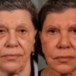 Sculptra Face Before and After Photos in Newburgh, NY, Patient 12791