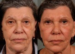 Sculptra Face Before and After Photos in Newburgh, NY, Patient 12791