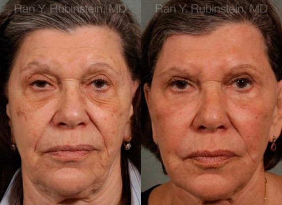 Sculptra Face Before and After Photos in Newburgh, NY, Patient 12791