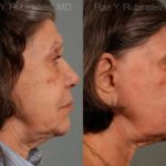 Sculptra Face Before and After Photos in Newburgh, NY, Patient 12791