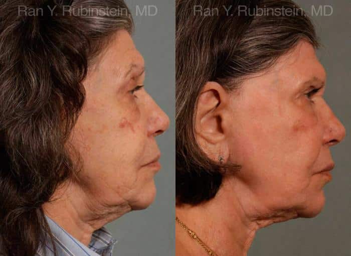 Sculptra Face Before and After Photos in Newburgh, NY, Patient 12791