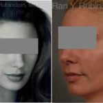 Dermal Fillers Before and After Photos in Newburgh, NY, Patient 12802