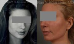 Dermal Fillers Before and After Photos in Newburgh, NY, Patient 12802