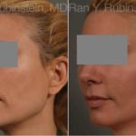 Dermal Fillers Before and After Photos in Newburgh, NY, Patient 12802