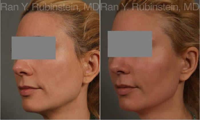 Dermal Fillers Before and After Photos in Newburgh, NY, Patient 12802