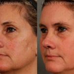 Laser Treatments Before and After Photos in Newburgh, NY, Patient 12817