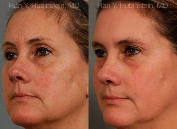 Laser Treatments Before and After Photos in Newburgh, NY, Patient 12817